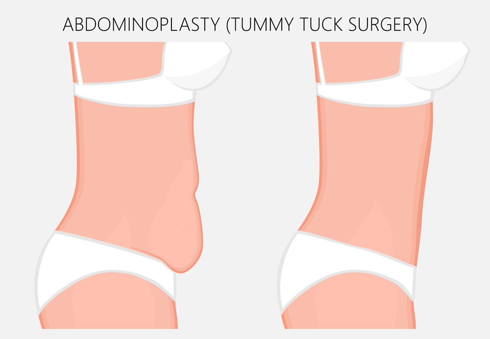 abdominoplasty surgery tummy tuck perth