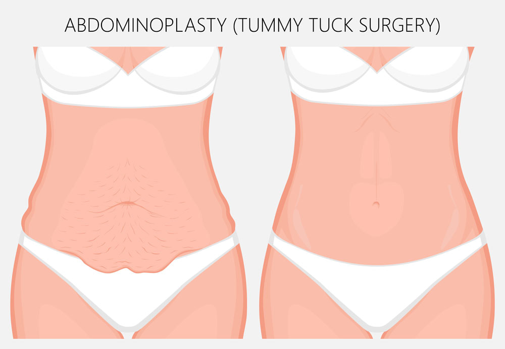 Tummy Tuck Abdominoplasty in Perth | Subiaco Plastic Surgery