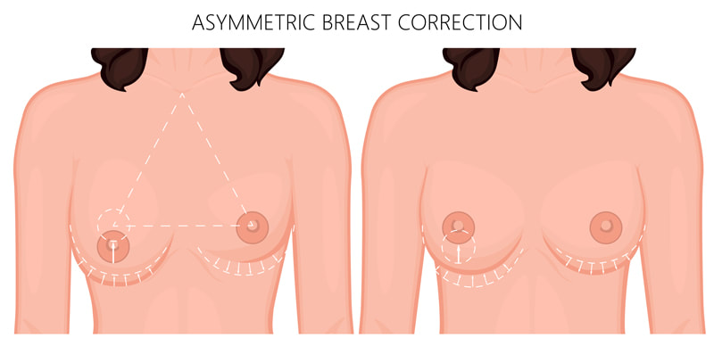 Breast Augmentation Correction Surgery Perth
