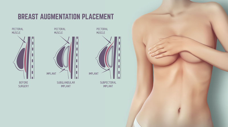Breast Augmentation Surgery Perth Plastic Surgeon