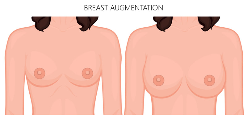 Breast Augmentation Surgery Perth