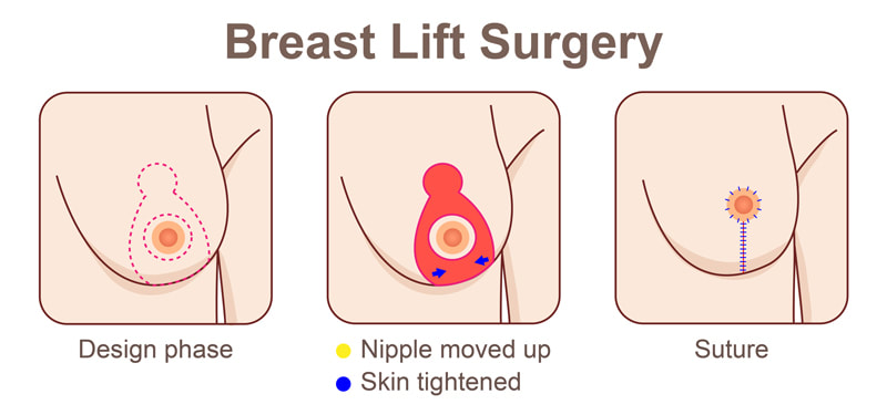Breast Lift With Implants Surgery Plastic Surgery In Perth