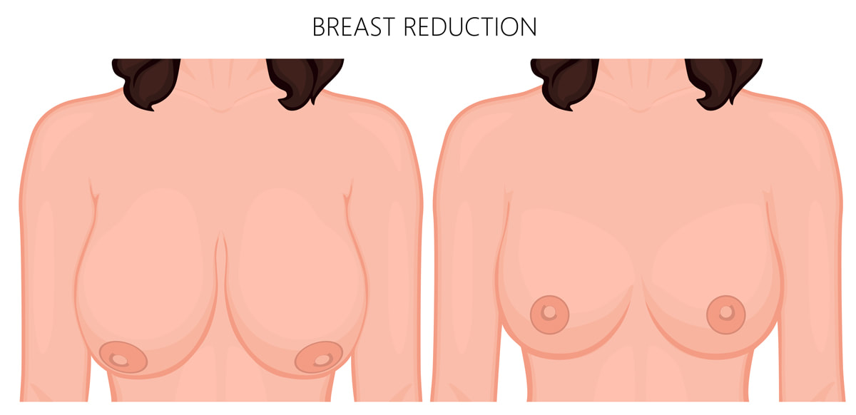 Breast reduction surgery perth plastic surgeon
