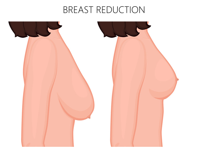 Breast Reduction Surgeon In Perth Specialist Plastic Surgeon