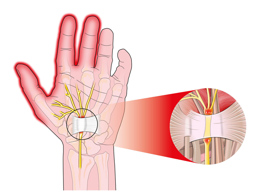 carpal tunnel surgery doctor
