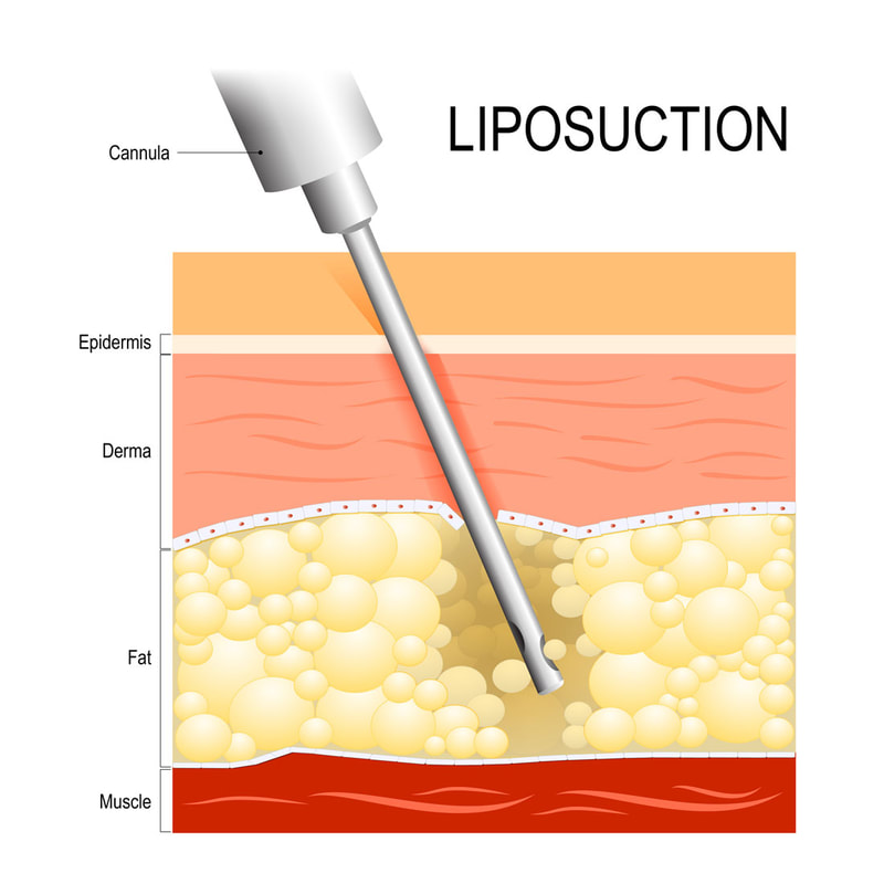 liposuction surgery perth