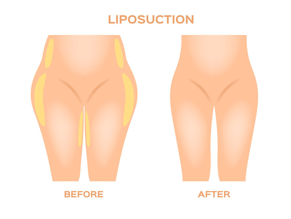 liposuction surgeon perth