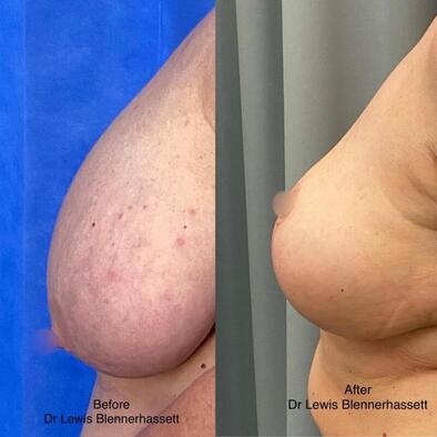 Can my breasts get bigger after a breast reduction? - Dr. Hess